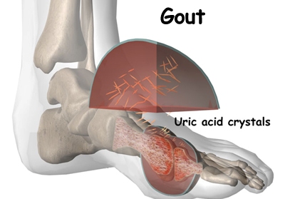 What are some gout cures?
